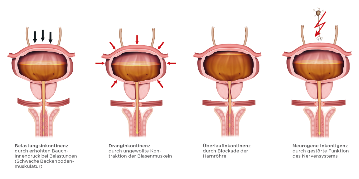 Inkontinenz und was man dagegen tun kann Selbsthilfe Prostatakrebs